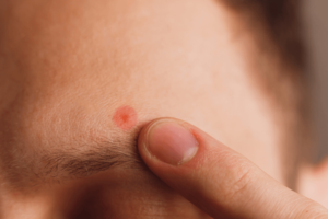 眉間や眉毛にできたニキビのスピリチュアルな意味とは？